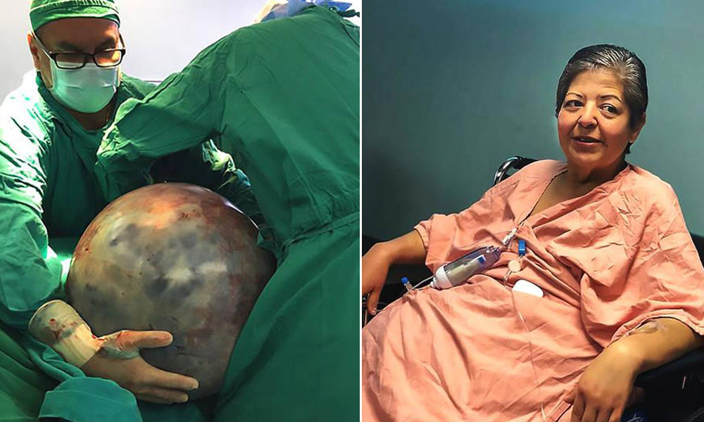 哥斯达黎加女子体内取出68斤重巨型肿瘤